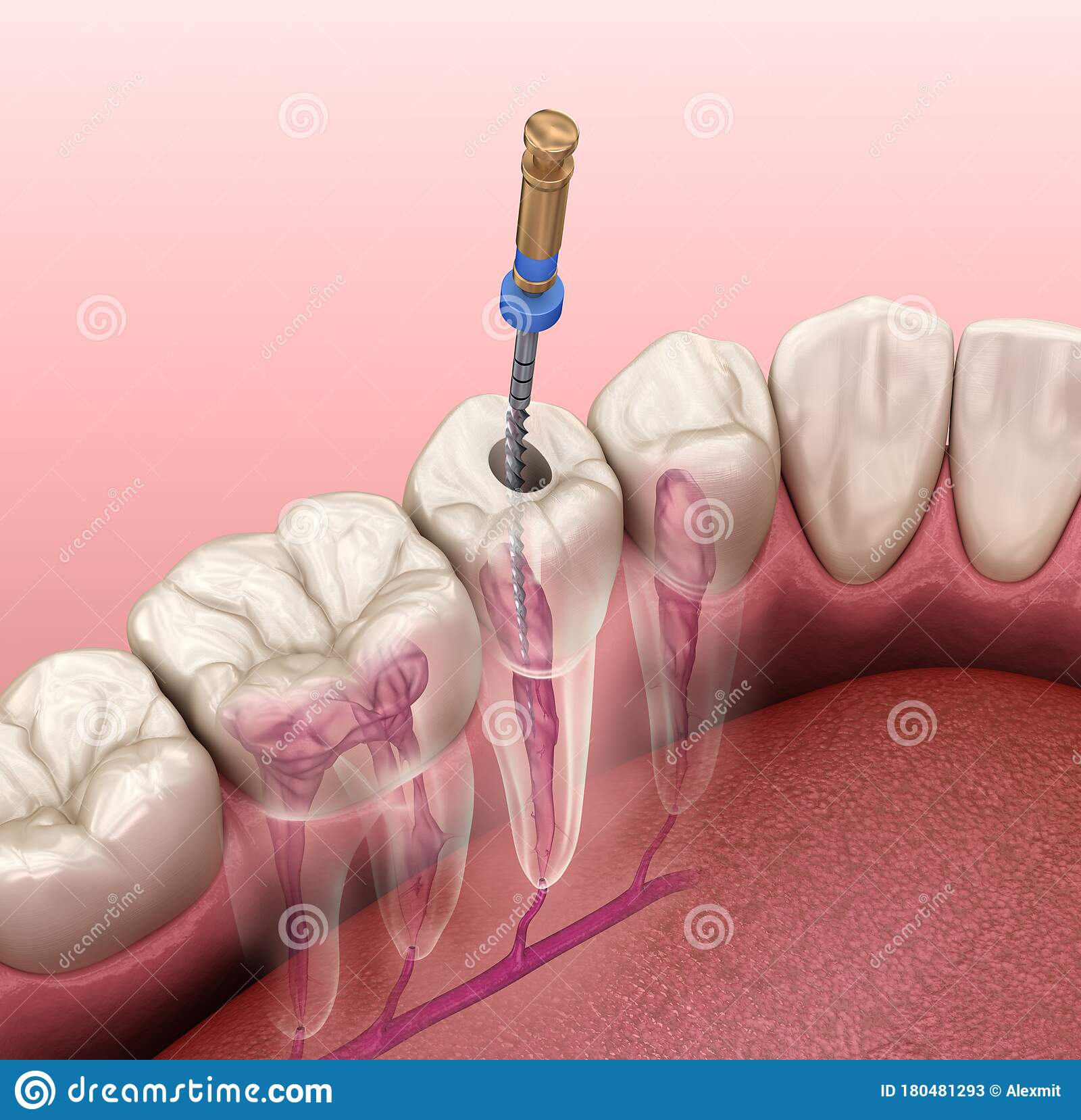 How painful is root canal treatment? Uganda Dental Association