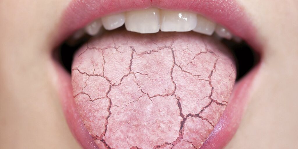 DRY MOUTH XEROSTOMIA Uganda Dental Association DRY MOUTH XEROSTOMIA Uganda Dental Association