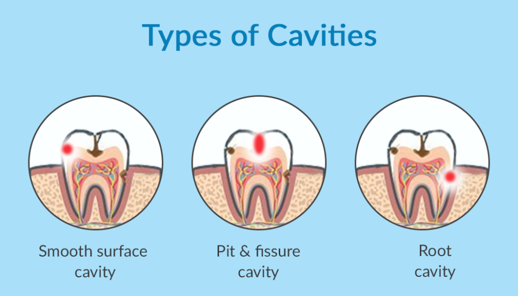 types-of-cavities