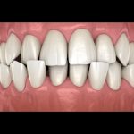 misaligned-teeth